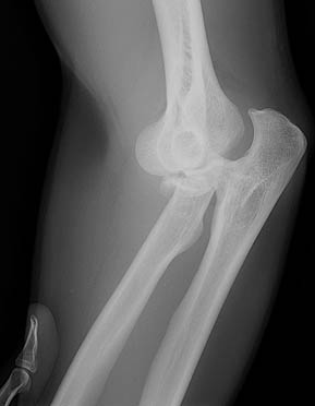 Broken bone searching for Lost Monarch redwood